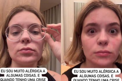 Viih Tube choca seguidores ao mostrar reação alérgica no rosto! Confira imagens - Metropolitana FM