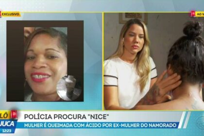 Alô Juca: mulher atacada com ácido pela ex do companheiro.