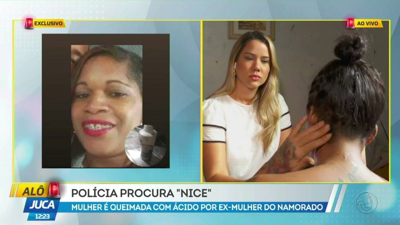 Alô Juca: mulher atacada com ácido pela ex do companheiro.