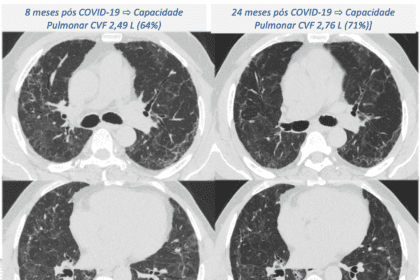 Estudo aponta que sequelas pulmonares podem se agravar até dois anos após internação por COVID-19 severa