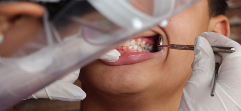 Substância secreta por fungos pode ser eficaz contra biofilme causador de cárie dental