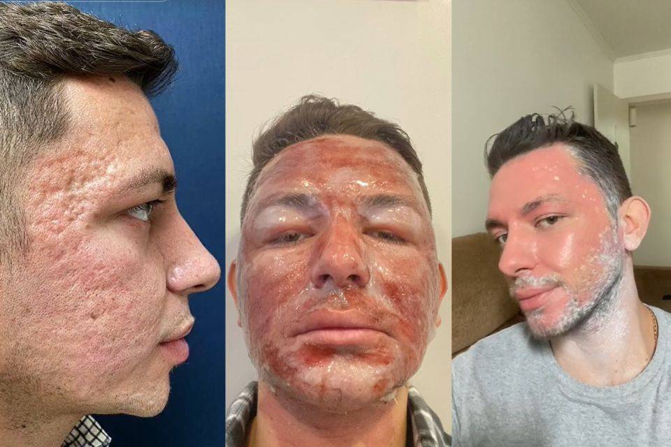 CFM solicita liberação do uso de fenol por médicos pela Anvisa.