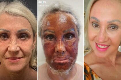 Projeto de lei exige notificação de complicações pós peeling de fenol