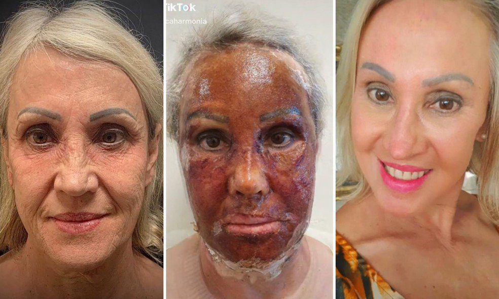 Projeto de lei exige notificação de complicações pós peeling de fenol