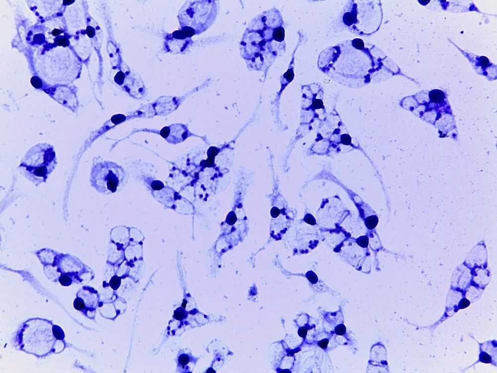 Identificação de cepa resistente ao tratamento em paciente com leishmaniose cutânea