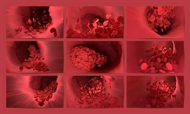 Excesso de açúcar no sangue aumenta o risco de trombose: estudo revela impacto da glicose elevada na coagulação sanguínea
