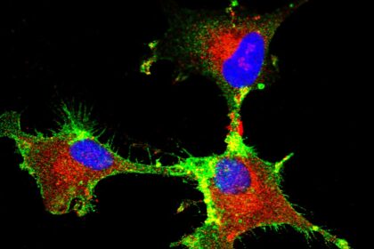 Pesquisa Identifica Proteína Fundamental na Progressão do Glioblastoma, um Tipo de Tumor Cerebral