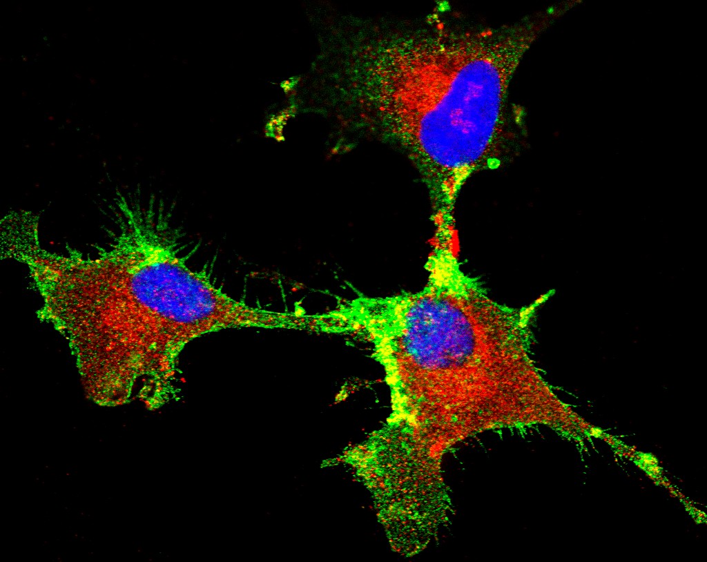 Pesquisa Identifica Proteína Fundamental na Progressão do Glioblastoma, um Tipo de Tumor Cerebral