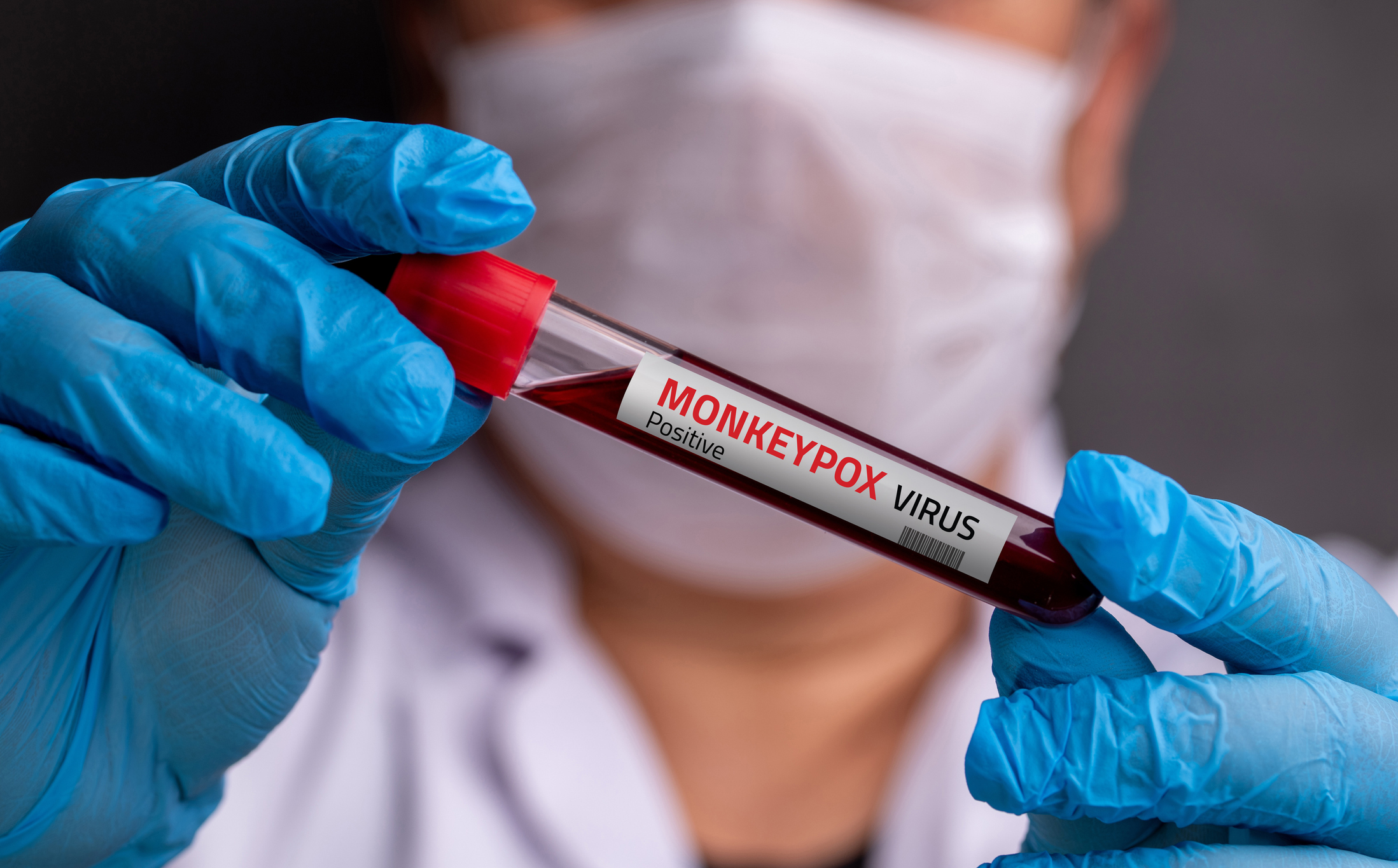 Nova cepa do mpox confirmada em São Paulo é mais agressiva