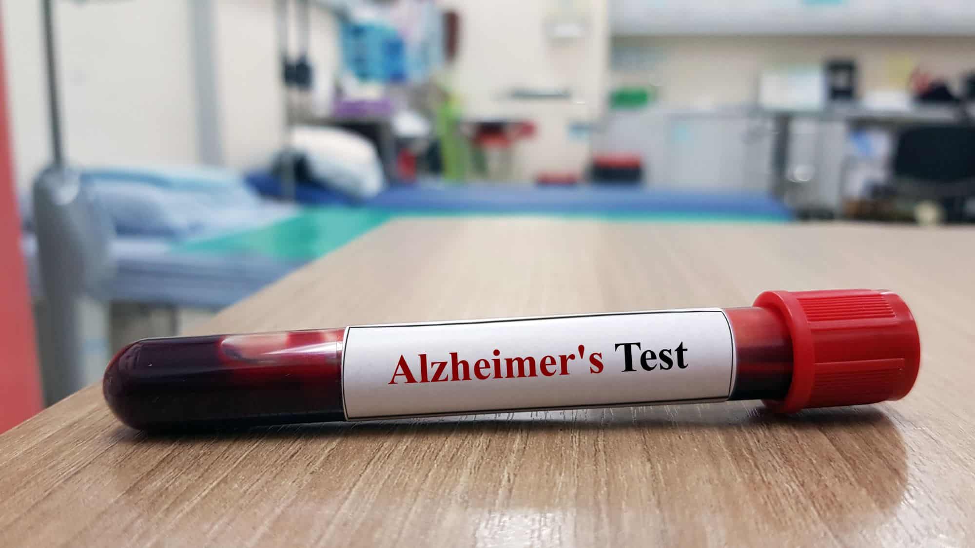 Novo exame de sangue pode melhorar tratamentos do Alzheimer