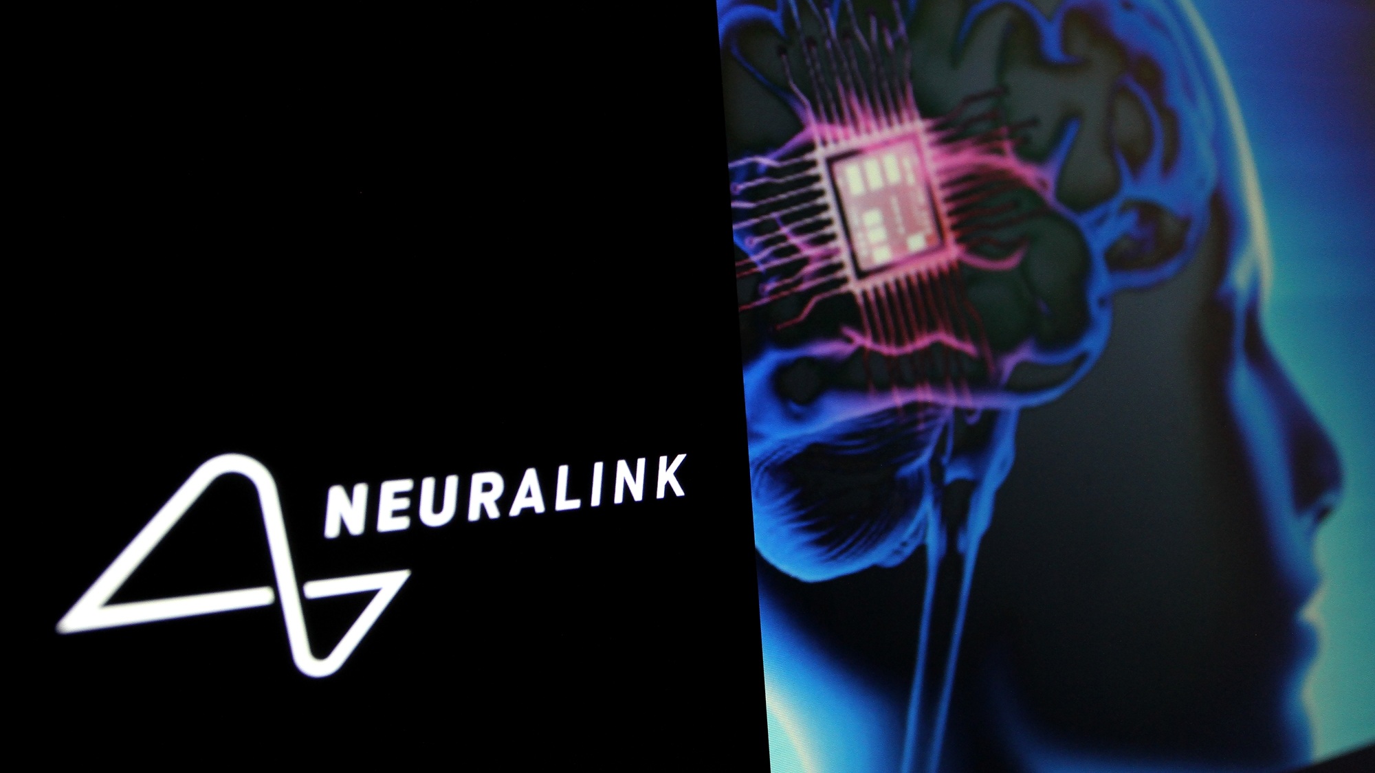 Homem com ELA usa implante da Neuralink para se comunicar
