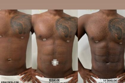 Lipo HD: Davi Brito Revela Resultados Surpreendentes!