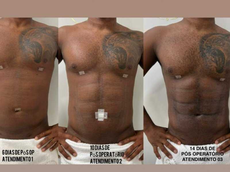 Lipo HD: Davi Brito Revela Resultados Surpreendentes!