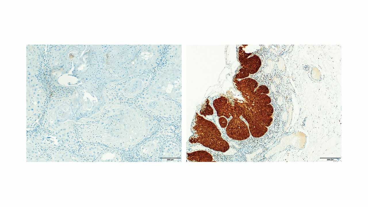 Bactéria Oral Comum Pode Prever Evolução do Câncer de Cabeça e Pescoço, Indica Estudo