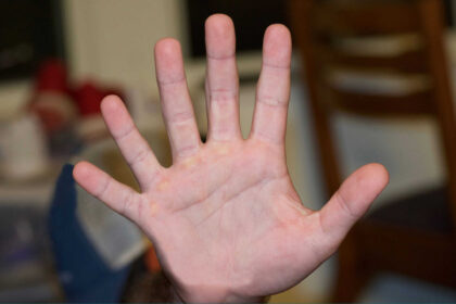 O que é polidactilia? Entenda por que algumas pessoas têm dedos a mais