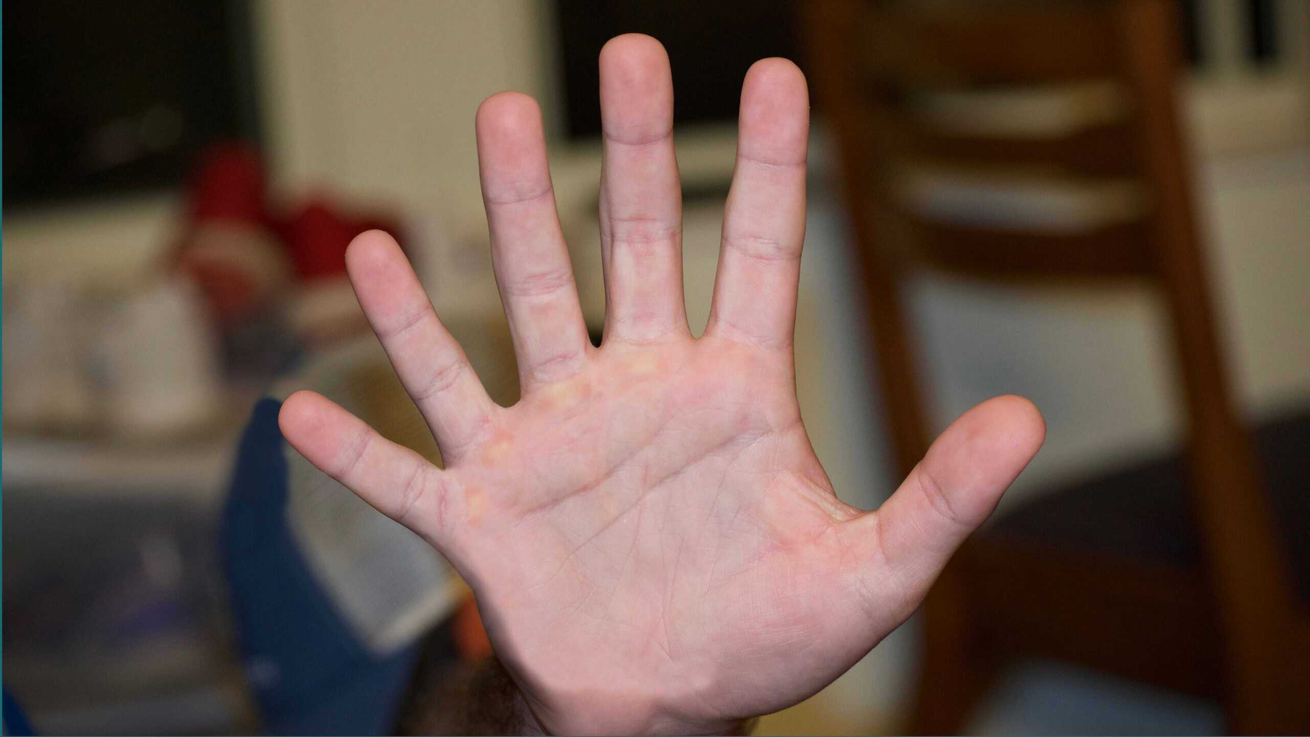 O que é polidactilia? Entenda por que algumas pessoas têm dedos a mais
