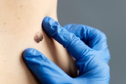 Genes que Preveem a Resposta de Pacientes com Melanoma à Imunoterapia: Descobertas Recentes