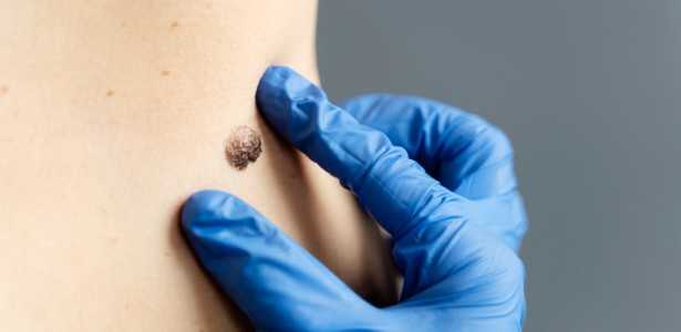Genes que Preveem a Resposta de Pacientes com Melanoma à Imunoterapia: Descobertas Recentes