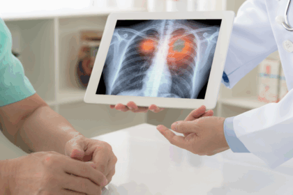Câncer de Pulmão: Sintomas, Diagnóstico e Tratamentos Essenciais