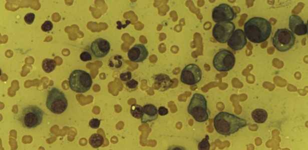 Corte de 50% nos Custos de Tratamento para Câncer no Sangue: Novo Projeto Inovador