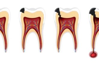 Como Exercícios Físicos e Ômega-3 Podem Reduzir a Gravidade de Infecções na Raiz do Dente