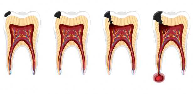 Como Exercícios Físicos e Ômega-3 Podem Reduzir a Gravidade de Infecções na Raiz do Dente