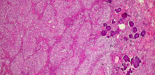 Descubra Potenciais Alvos Terapêuticos para Tratamento de Câncer Infantil Raro