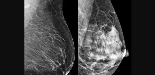Como a Combinação de Computação Quântica e Clássica Potencializa o Diagnóstico Precoce do Câncer de Mama