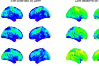 Neuroinflamação Precoce em Síndrome de Down: Entenda a Relação com a Alta Prevalência de Alzheimer