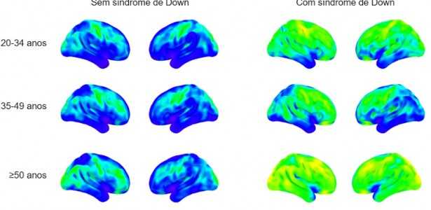Neuroinflamação Precoce em Síndrome de Down: Entenda a Relação com a Alta Prevalência de Alzheimer