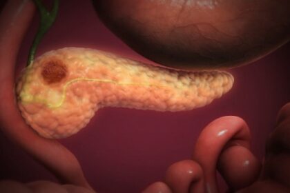 Descoberta de Proteína Relacionada ao Avanço do Câncer de Pâncreas Através dos Nervos