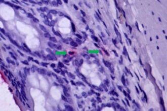 Dano Gastrointestinal e sua Relação com a Agravação da Febre Amarela