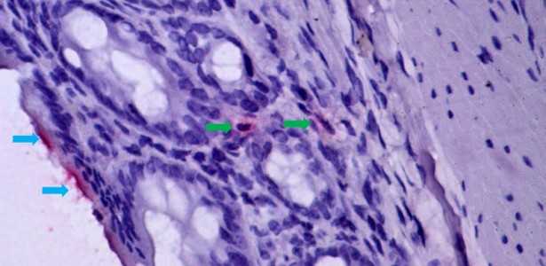 Dano Gastrointestinal e sua Relação com a Agravação da Febre Amarela