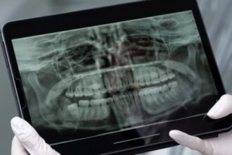 Saliva Artificial: Protegendo Dentes de Pacientes com Câncer de Cabeça e Pescoço