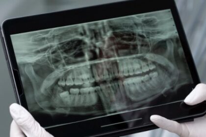 Saliva Artificial: Protegendo Dentes de Pacientes com Câncer de Cabeça e Pescoço