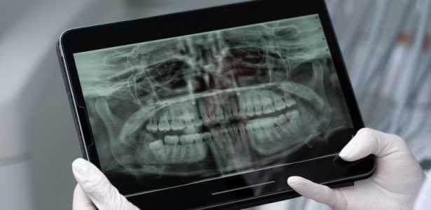 Saliva Artificial: Protegendo Dentes de Pacientes com Câncer de Cabeça e Pescoço