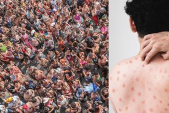 Porto Alegre registra primeiro caso de Mpox em 2026 e Brasil entra em alerta: o que você precisa saber