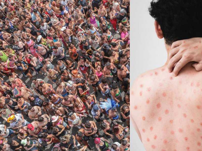 Porto Alegre registra primeiro caso de Mpox em 2026 e Brasil entra em alerta: o que você precisa saber