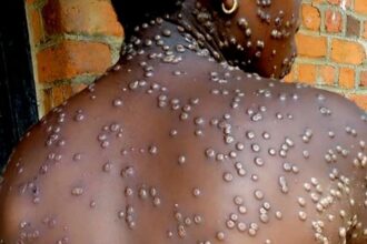 Mpox no Brasil: Sintomas, transmissão e prevenção revelados