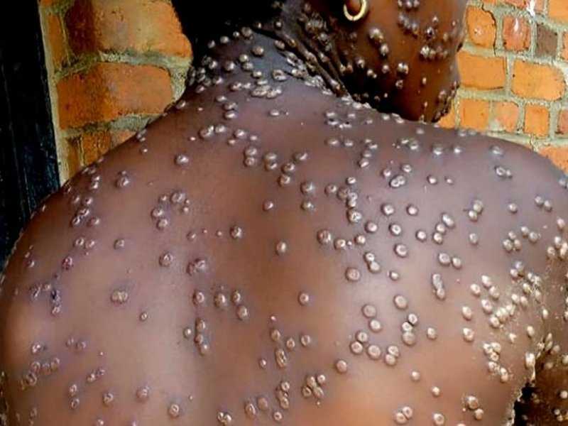 Mpox no Brasil: Sintomas, transmissão e prevenção revelados