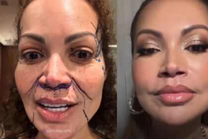 Lifting Facial de Solange Almeida: Resultados que Impressionam!