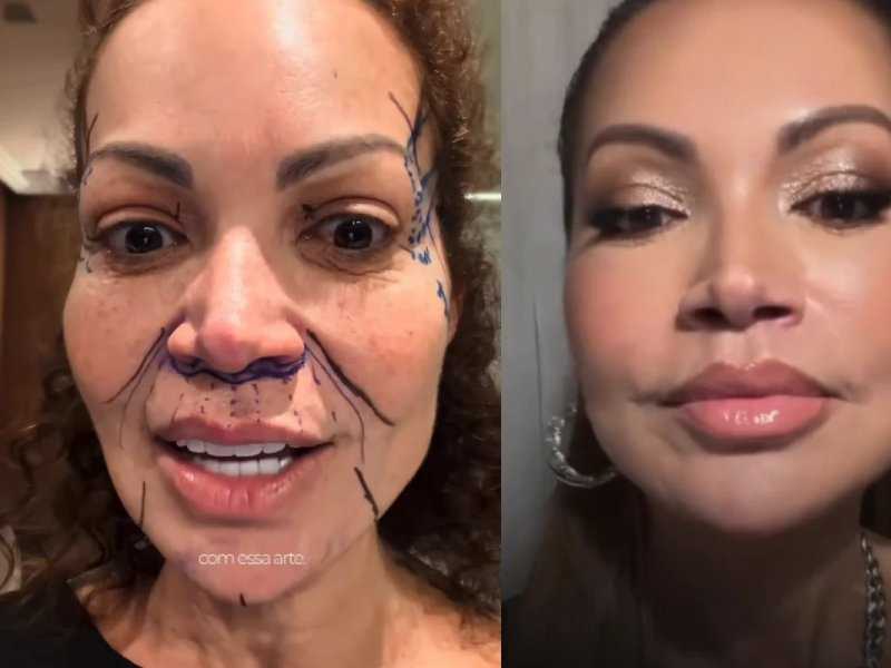 Lifting Facial de Solange Almeida: Resultados que Impressionam!