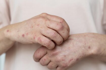 Mpox sob Controle: Segundo Ministério da Saúde garante tranquilidade e segurança