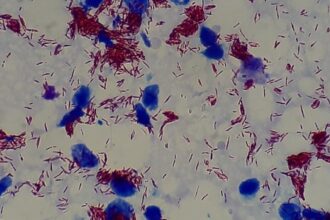 Exame de Sangue com Inteligência Artificial: Novo Caminho para Diagnóstico Precoce da Hanseníase