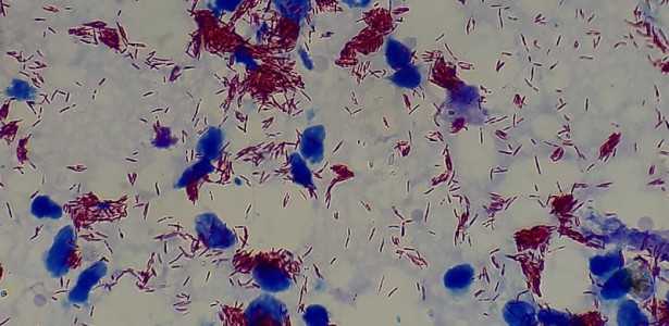 Exame de Sangue com Inteligência Artificial: Novo Caminho para Diagnóstico Precoce da Hanseníase